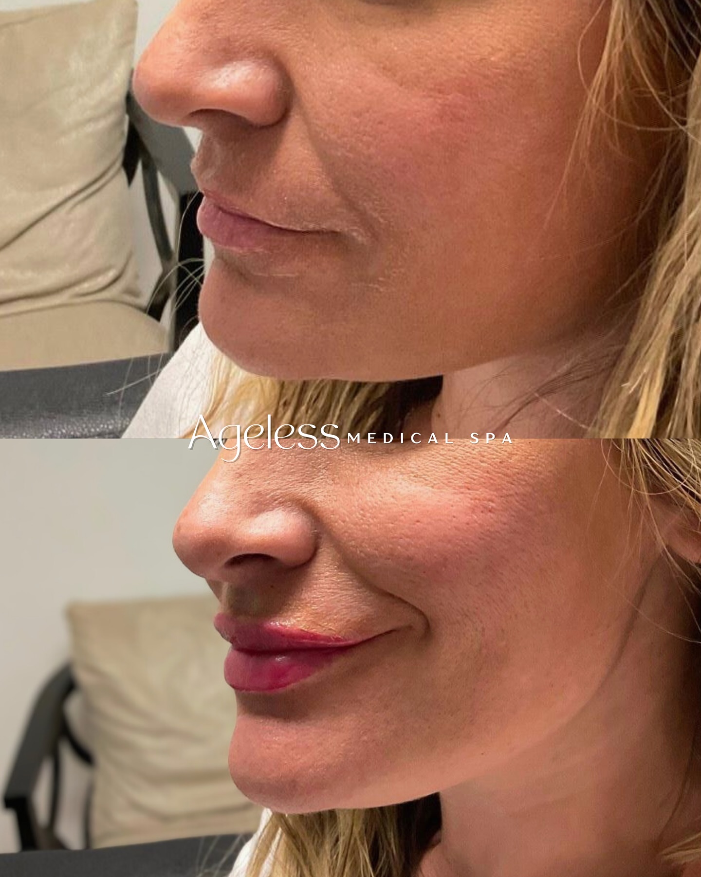 A little volume can make all the difference💕 Book your free lip consult today and achieve results like these✨