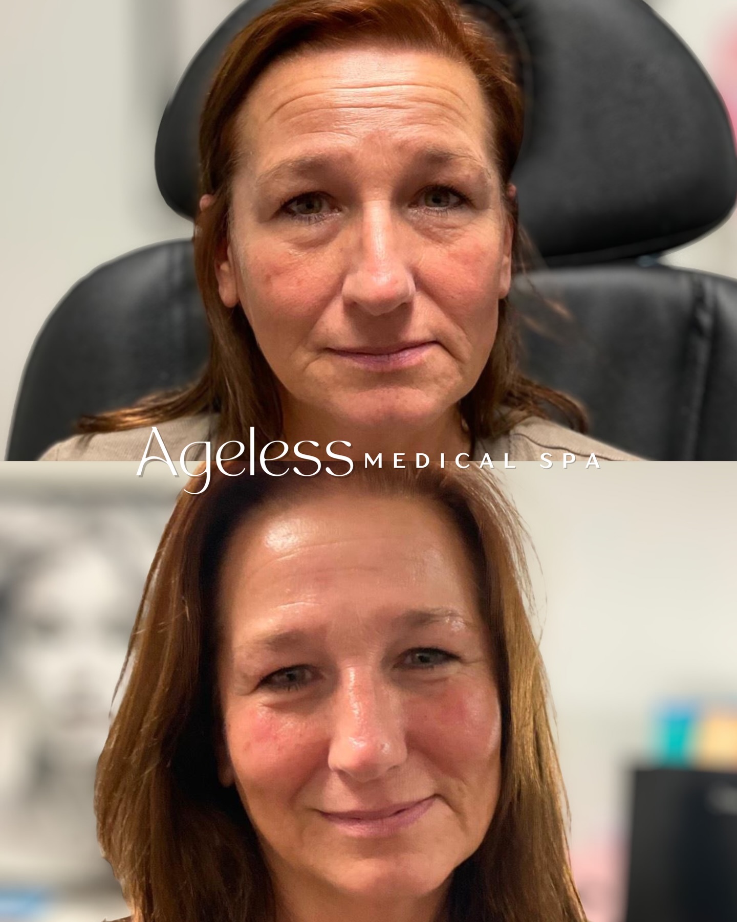 Sometimes the smallest changes make the biggest difference✨ If tired eyes have been holding you back, we can help. Book your free consult today and take the first step towards a refreshed look🫶