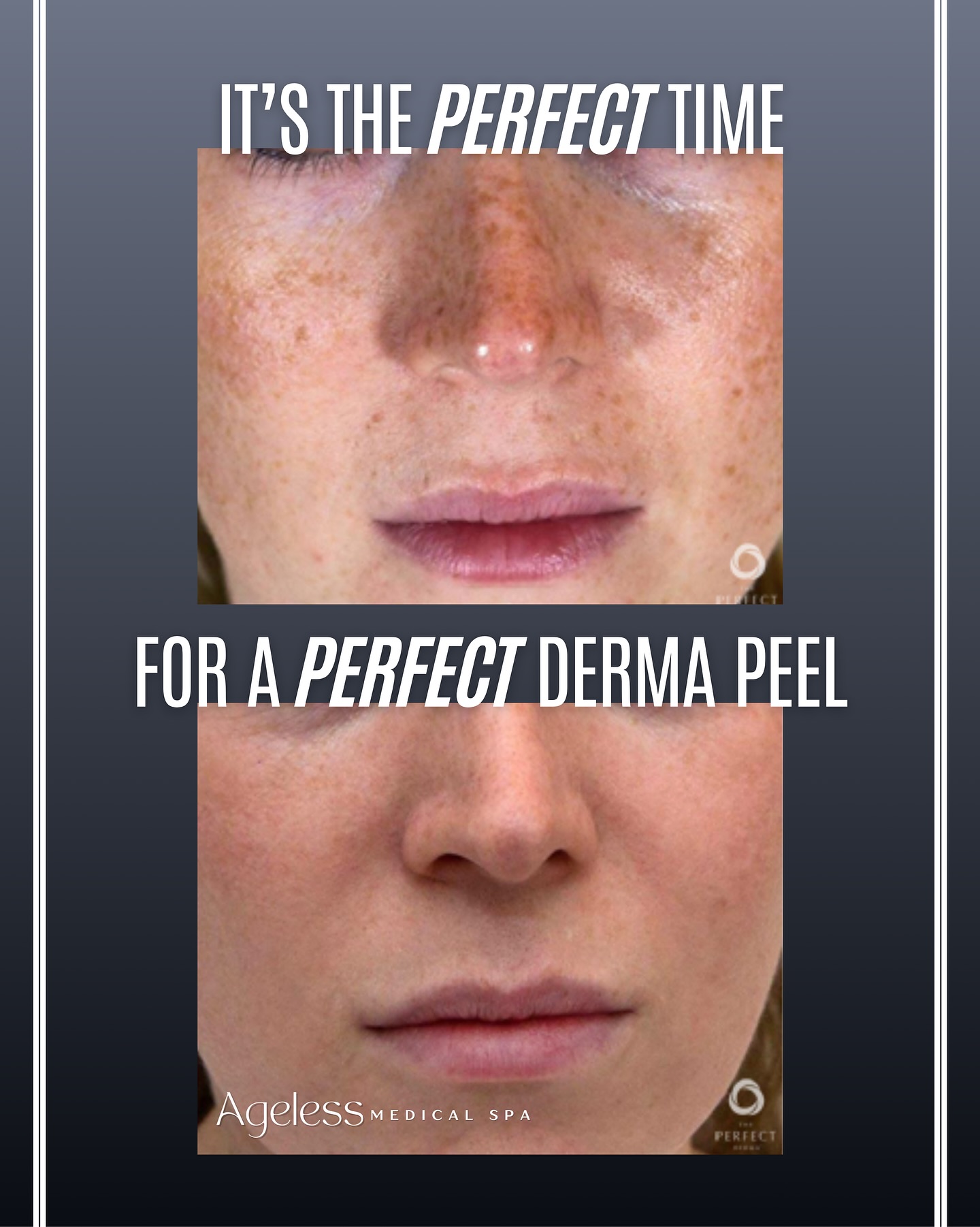 Our most popular peel that improves skin tone, reduces acne scars, softens fine lines, and stimulates collagen production✨ If you’ve been searching for a safe and effective chemical peel for glowing, healthy skin, October is the ideal time to book. Schedule your appointment today and save $25🫶