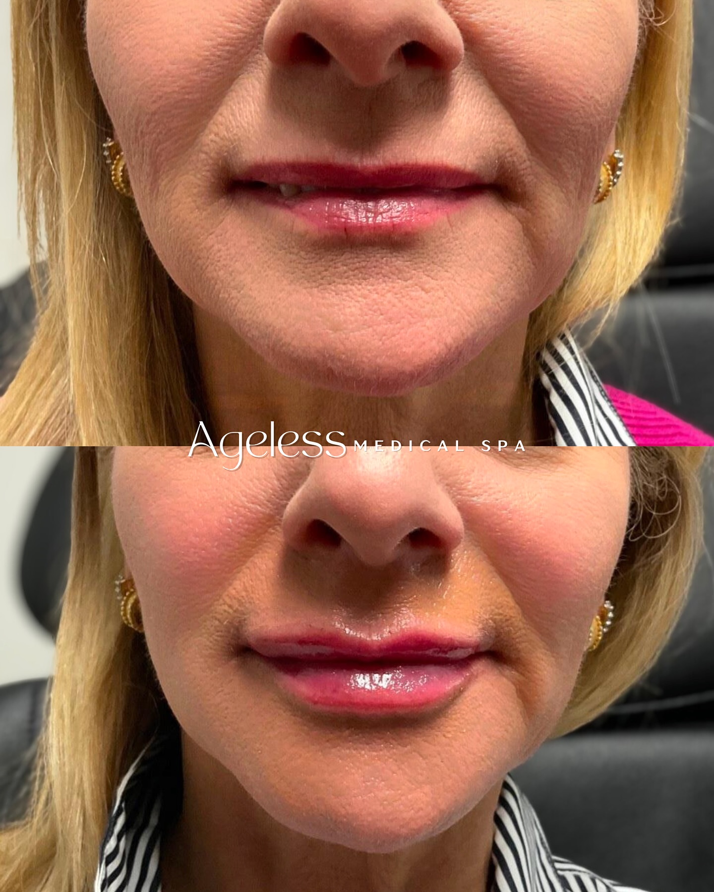 A soft, refined pout makes all the difference✨ Book your November lip filler and receive a complimentary Lip Conditioner to keep your results hydrated and flawless🫶