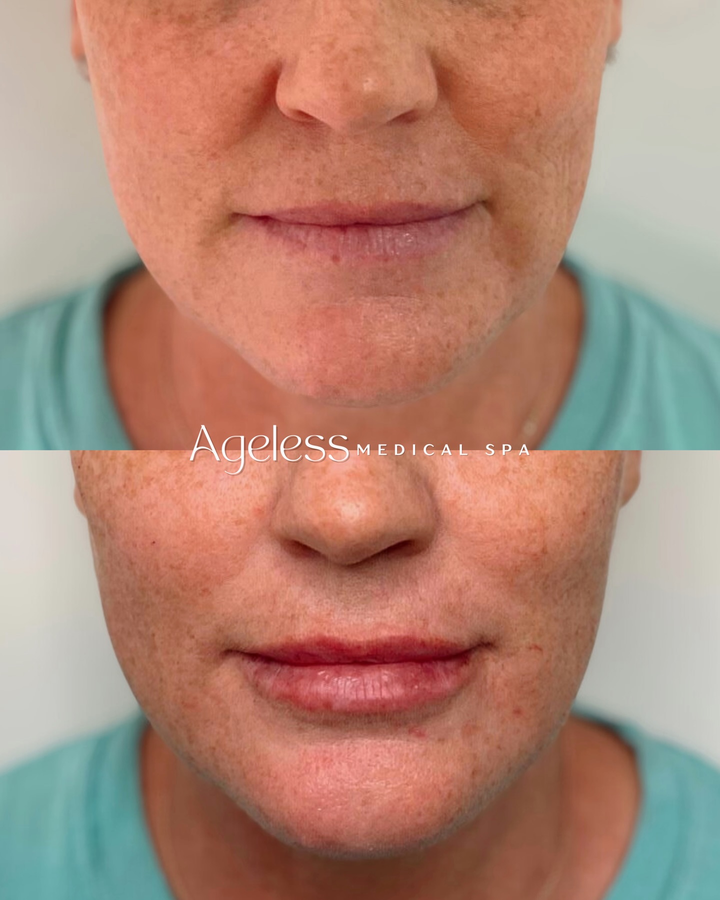 Spring cleaning… but for your lip lines💋 This is your sign to book a custom lip filler appointment, done the right way🫶