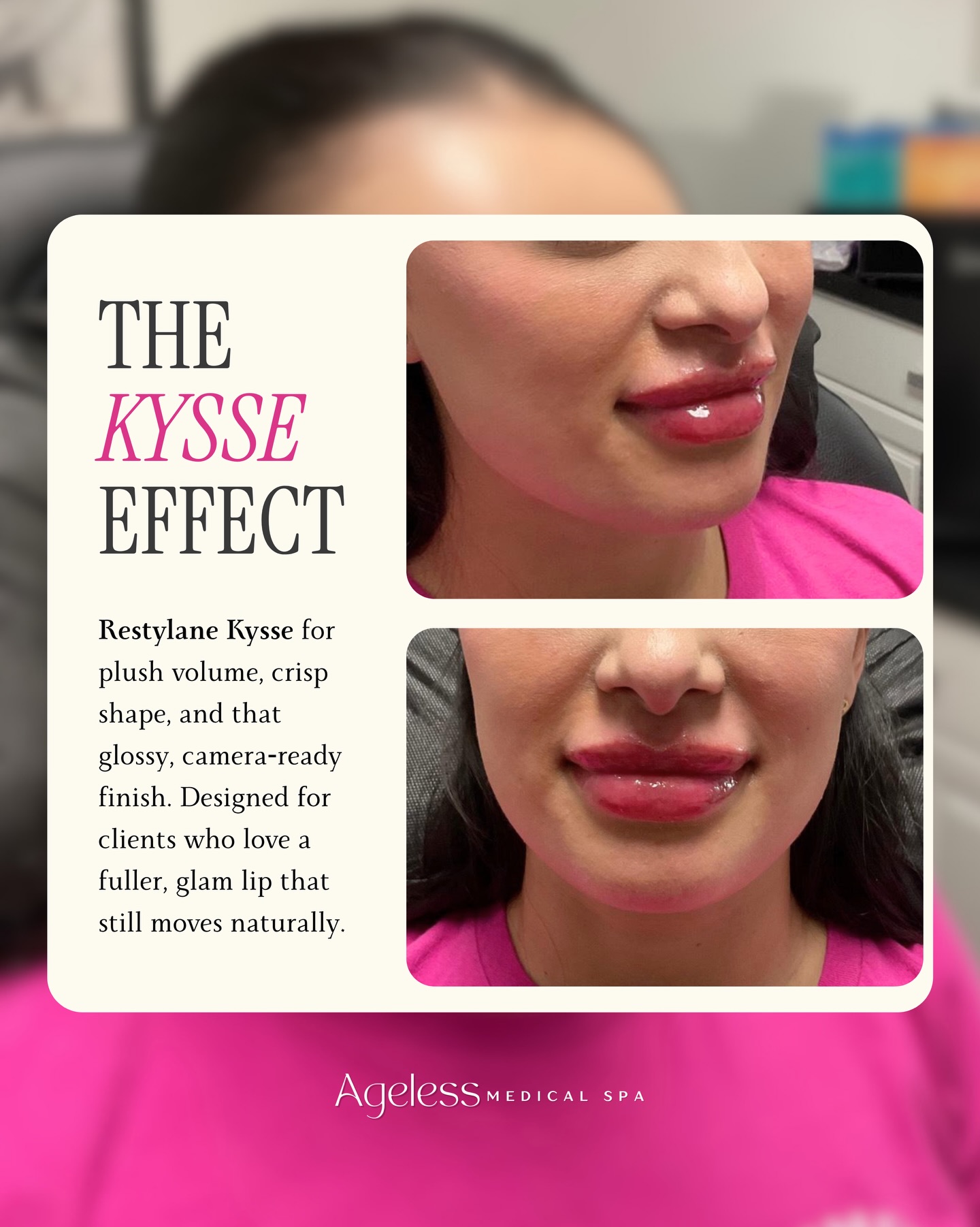 Whether you love a bold, statement pout or something softer, the right formula makes all the difference. Kysse is our go to choice for clients who want volume with natural flexibility💋 Call or message us today and we’ll create your perfect lip together✨
